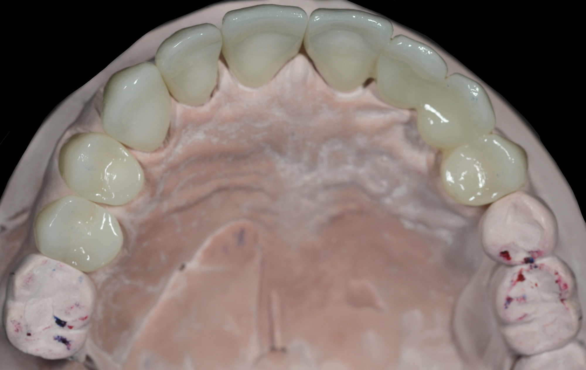 Upper Anterior Bridge